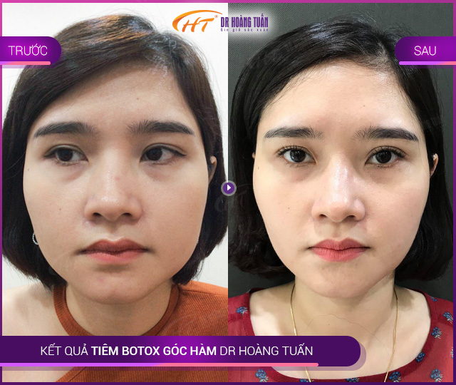 Kết quả dùng botox góc hàm tại Thẩm mỹ Hoàng Tuấn